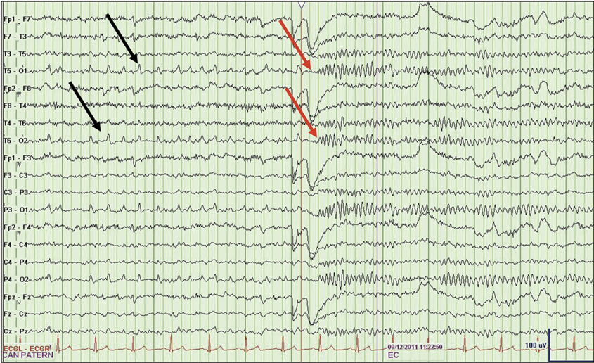A screenshot of twelve seconds of EEG showing twenty horizontal line graphs: nineteen black brainwaves and a red heart rate (EKG).